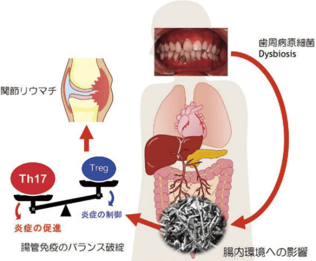 歯周病と関節リウマチの新たな関連メカニズム